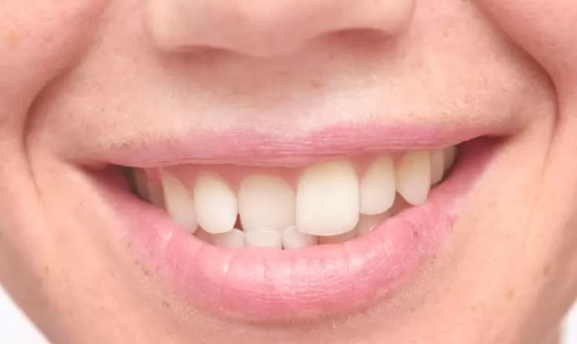 Chỉnh răng mọc lệch bao nhiêu tiền và các phương pháp thực hiện