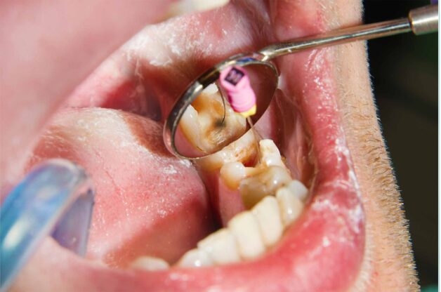 Sâu răng là một trong những nguyên nhân phổ biến nhất gây viêm tủy răng.