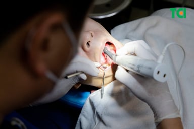 Quy trình điều trị viêm tủy răng không hồi phục