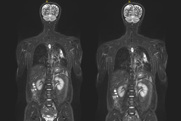 Chất lượng chụp cộng hưởng từ toàn thân như thế nào? Có nên thực hiện chụp cộng hưởng từ toàn thân thường xuyên?