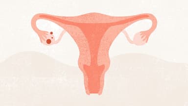 Tìm hiểu chung về bệnh ung thư buồng trứng