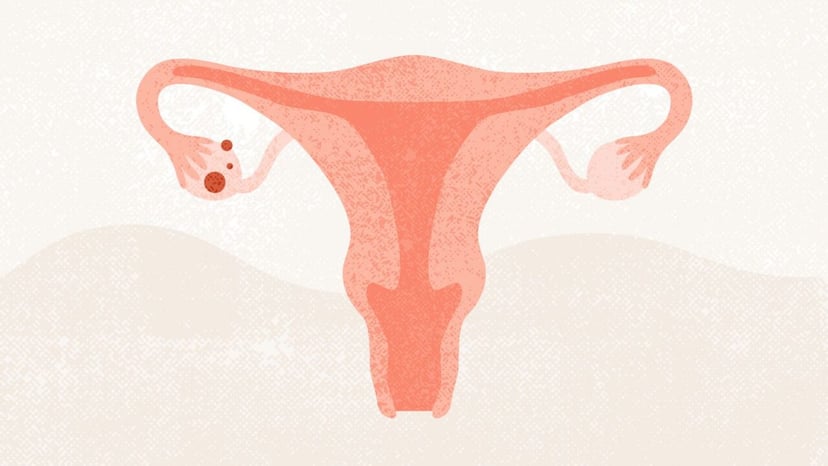 Tìm hiểu chung về bệnh ung thư buồng trứng