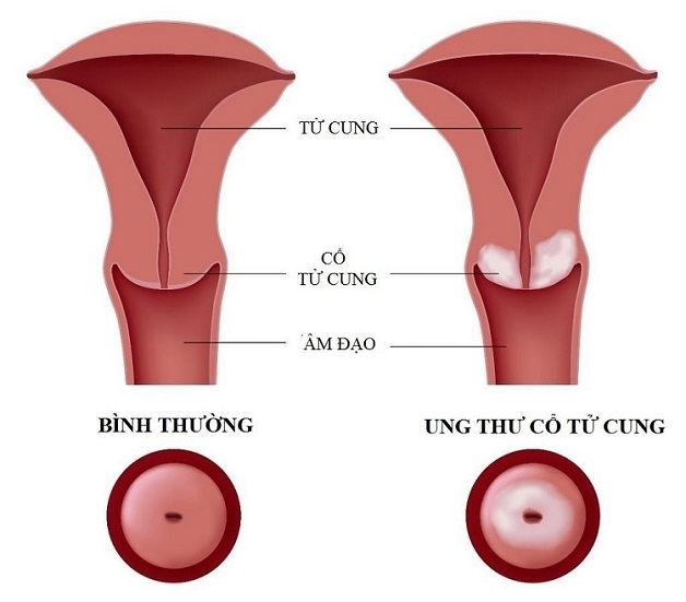sàng lọc ung thư cổ tử cung