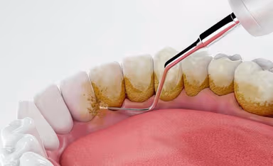 Hình ảnh vôi răng báo hiệu sức khỏe răng miệng