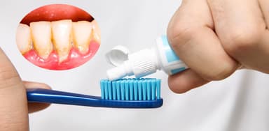 Giải đáp tìm kiếm về kem đánh răng trị cao răng