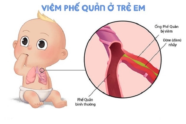 Lập kế hoạch chăm sóc cho bệnh nhân viêm phế quản như thế nào