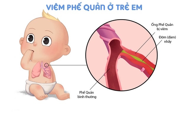 Trẻ mắc viêm phế quản sẽ dần xuất hiện những triệu chứng của bệnh