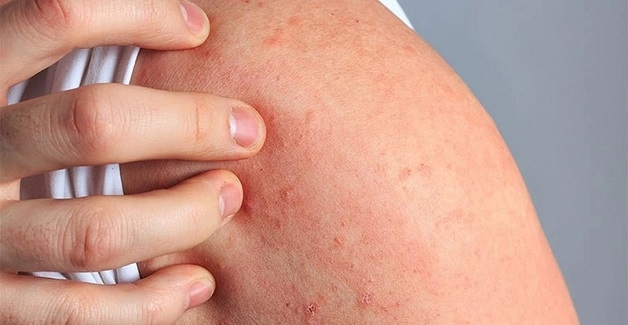 Dị ứng vắc xin