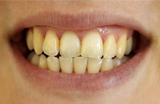 phương pháp loại bỏ mảng bám trên răng