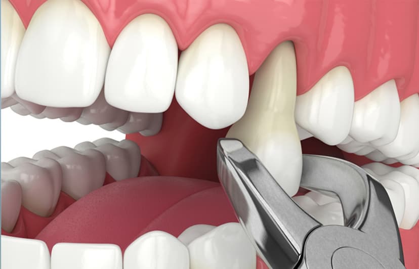 Nhổ răng ở đâu tốt và trường hợp cần thực hiện