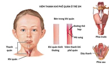 Phác đồ điều trị viêm thanh khí phế quản ở trẻ em