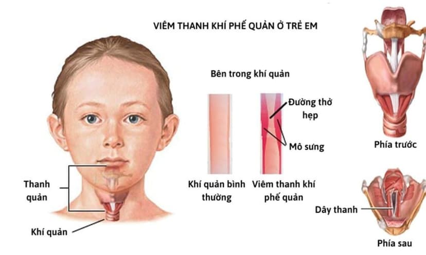 Phác đồ điều trị viêm thanh khí phế quản ở trẻ em