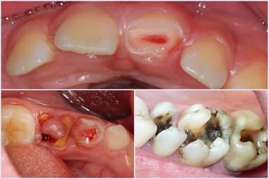 Nguyên nhân và cách xử lý răng sâu lồi thịt không đau