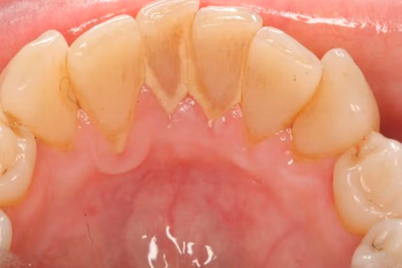 Giải đáp có nên tẩy cao răng tại nhà hay không