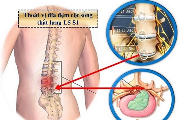 Tình trạng thoát vị đĩa đệm gây chèn ép dây thần kinh