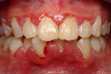 Thuốc bôi trị viêm nướu răng và những điều cần biết