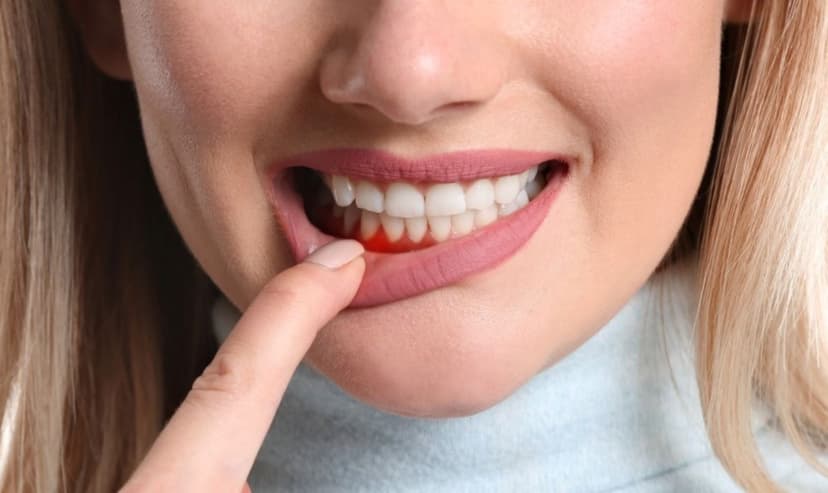 Những loại thuốc bôi viêm nướu răng bác sĩ có thể kê đơn