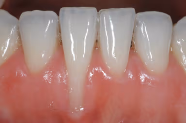 Tìm hiểu về tình trạng tụt lợi răng lung lay