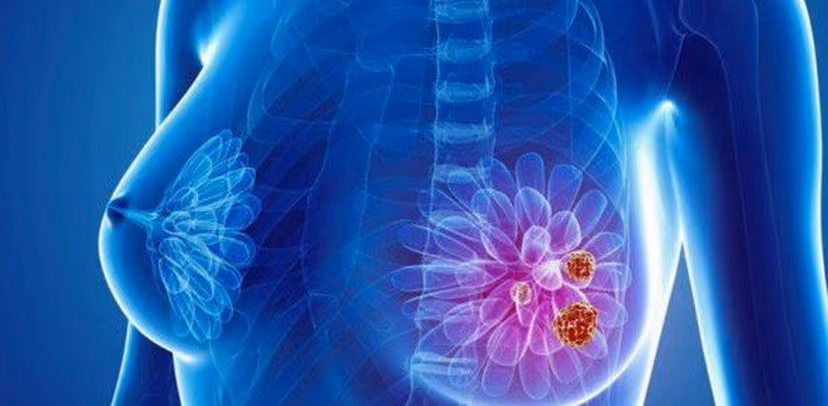 U vú BIRADS 4A có phải là tình trạng nguy hiểm?