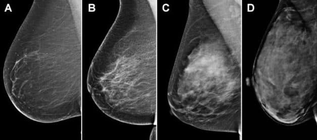 Nguyên nhân gây bệnh thường là do sự rối loạn nội tiết tố. Bên cạnh đó, yếu tố di truyền, gen, chế độ ăn uống, môi trường sống… cũng ảnh hưởng đến sự phát triển của khối u.