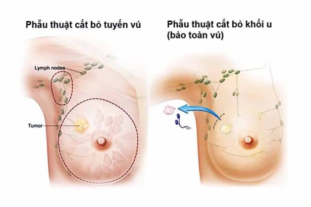 Hai phương pháp trong phẫu thuật ung thư vú.