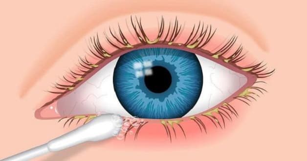 viêm bờ mi icd 10 là gì