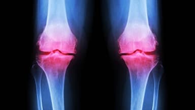 3 Bí quyết giúp bạn phòng thoái hóa khớp gối hiệu quả