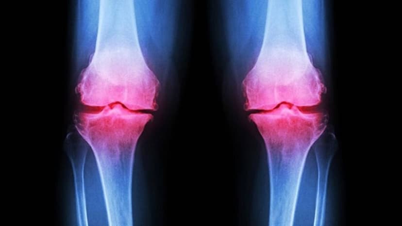 3 Bí quyết giúp bạn phòng thoái hóa khớp gối hiệu quả