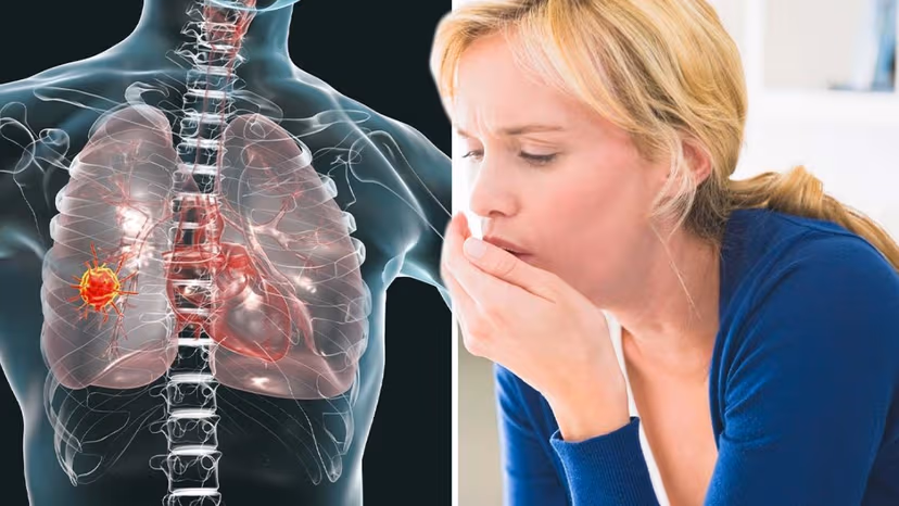 5 Dấu hiệu ung thư phổi giai đoạn đầu không thể bỏ qua