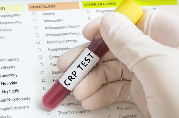Hình ảnh CRP test