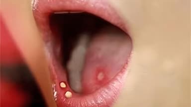 Tìm hiểu khả năng lây nhiễm của bệnh tình dục qua đường miệng