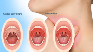 Tìm hiểu toàn bộ bệnh viêm amidan