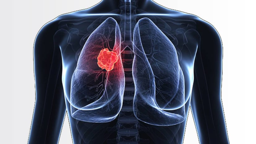 Lưu ý cho bạn về dấu hiệu của bệnh ung thư phổi
