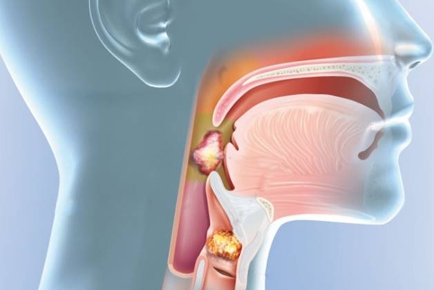 bệnh lý ung thư vòm họng