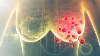 Cách phát hiện ung thư vú sớm hiệu quả và an toàn ít ai biết