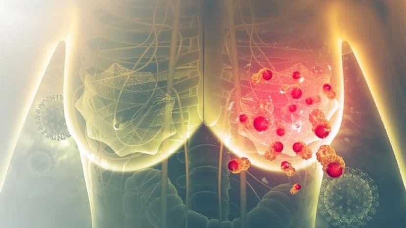 Cách phát hiện ung thư vú sớm hiệu quả và an toàn ít ai biết