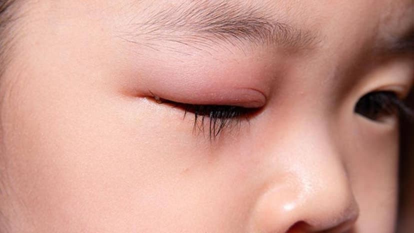 Đau mí mắt trên: Nguyên nhân và cách phòng tránh