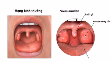 Các phương pháp điều trị viêm amidan phù hợp cho người bệnh
