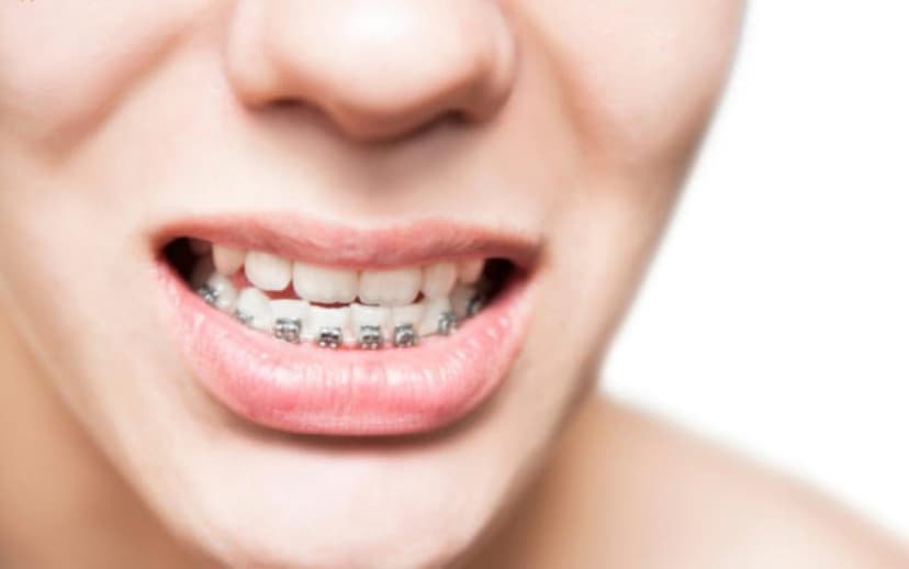 Niềng răng móm có đau không và lưu ý