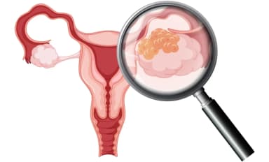 Phân biệt triệu chứng ung thư buồng trứng và cổ tử cung