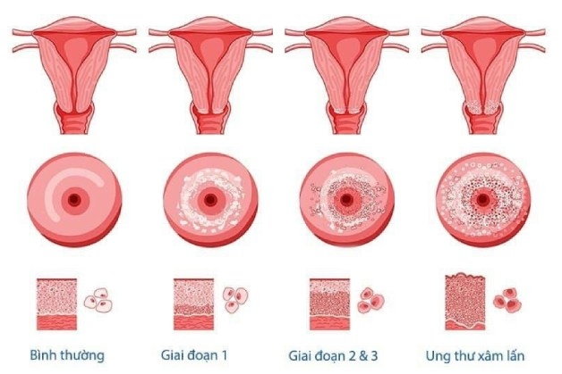 ung thư cổ tử cung có mấy giai đoạn