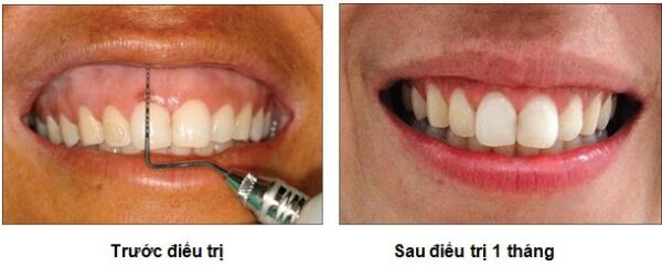 Phẫu thuật cười hở lợi bao nhiêu tiền