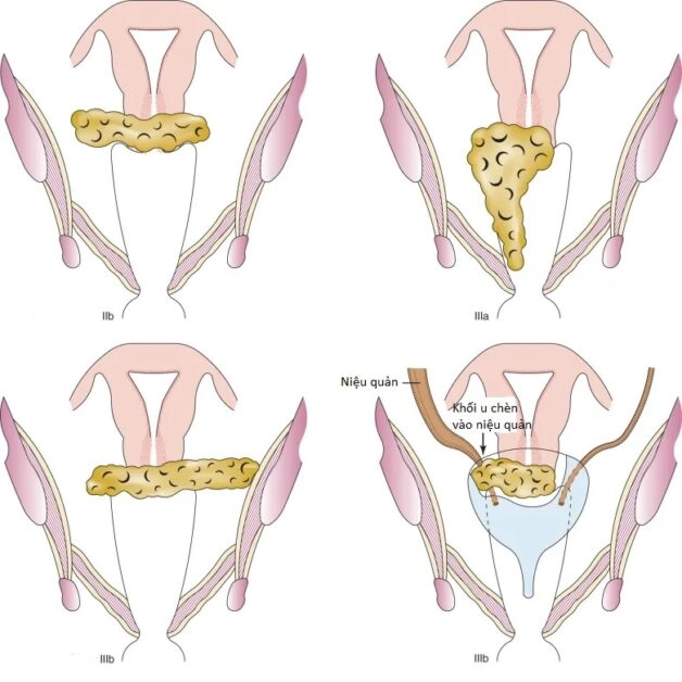 Ung thư cổ tử cung giai đoạn 3 và triển vọng