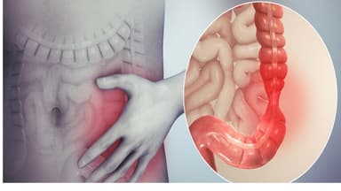 Biểu hiện ung thư đại tràng và biện pháp phát hiện sớm