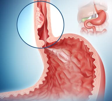 Các thông tin về bệnh ung thư thực quản