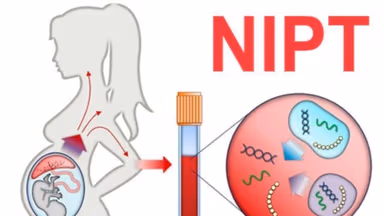 Những điều cần biết trước khi làm xét nghiệm sàng lọc Nipt