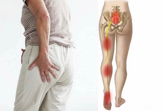 đau dây thần kinh tọa