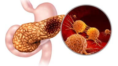 8 Phương pháp giúp điều trị ung thư tuyến tụy