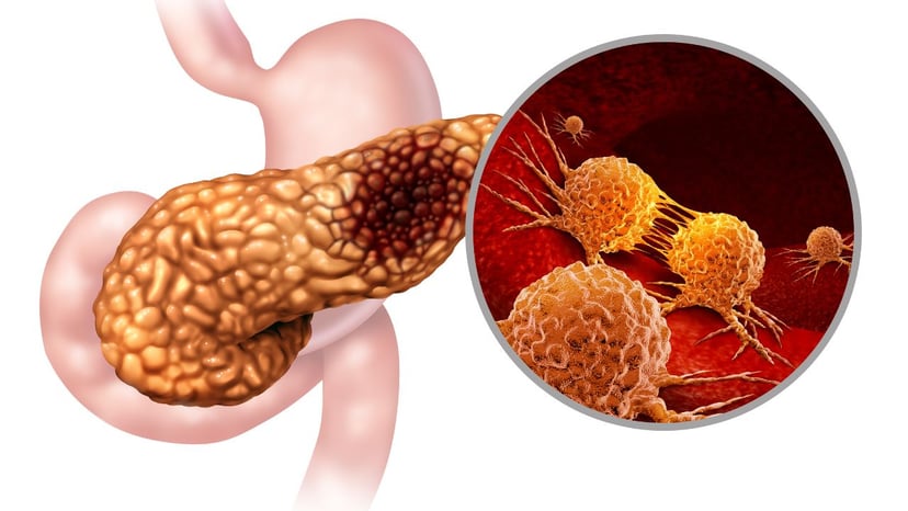 8 Phương pháp giúp điều trị ung thư tuyến tụy