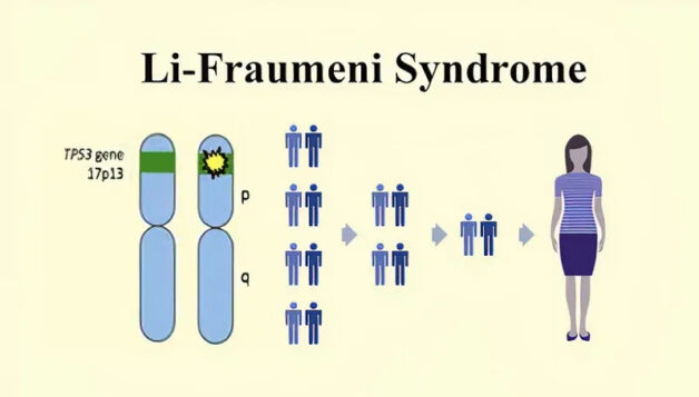 U tuyến thượng thận ác tính do hội chứng Li-Fraumeni